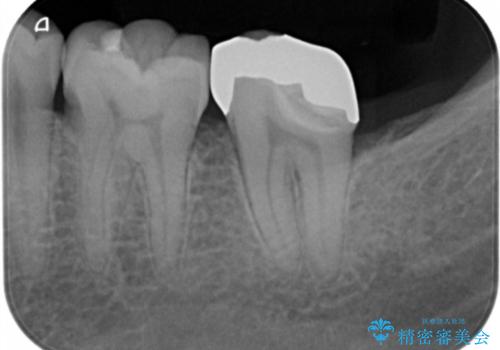 他院で入れたセラミックインレーが取れた。の治療後