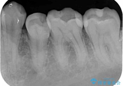 奥歯の詰め物の変色 セラミッククラウンでのやり替えの治療前