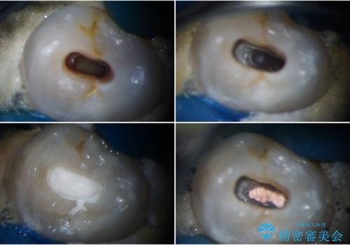 食事の度に痛む 根管治療とオールセラミッククラウンの治療中