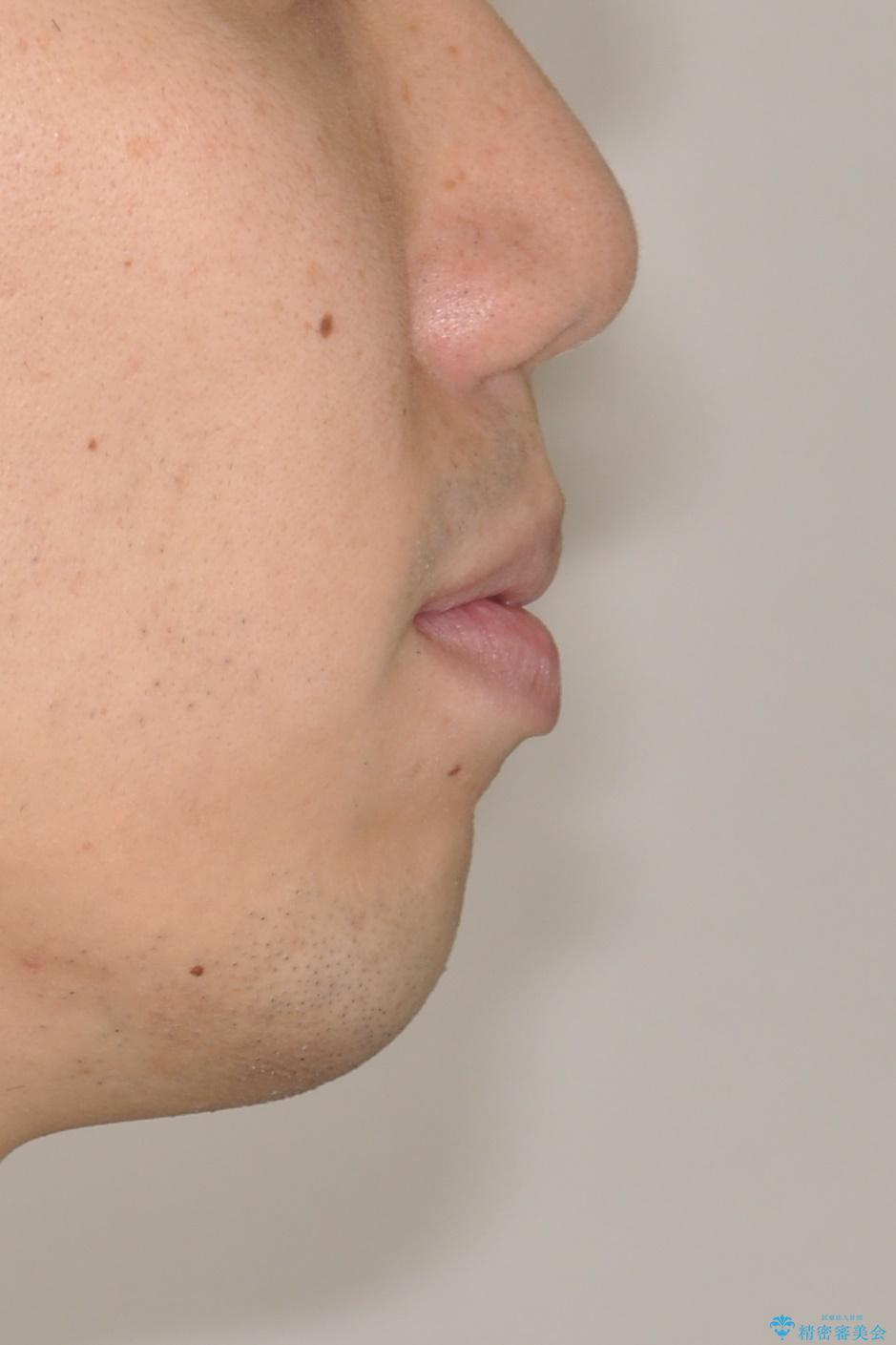 前歯の隙間を閉じたい 口元も下げたい ハーフリンガルによる抜歯矯正の治療前(顔貌)