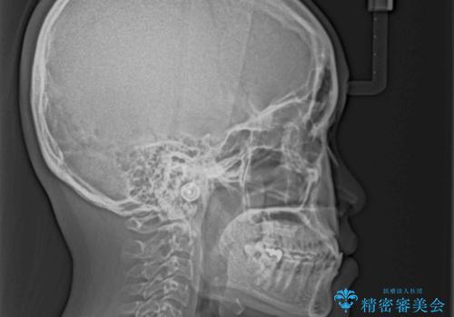 前歯の反対咬合 急速拡大装置とワイヤー装置であっという間の矯正治療の治療前