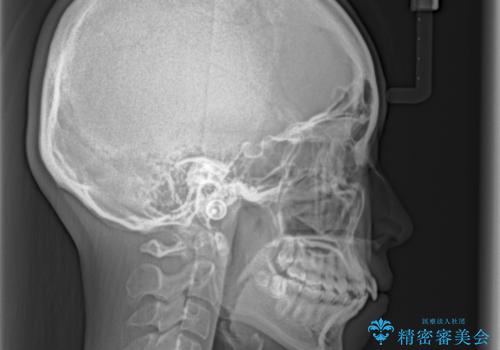 【モニター】前歯のクロスバイトをインビザラインで治療の治療前