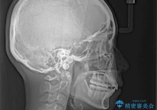 【モニター】前歯のクロスバイトをインビザラインで治療の治療後