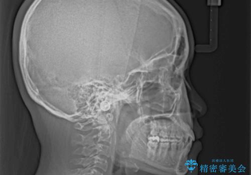 前歯の反対咬合 急速拡大装置とワイヤー装置であっという間の矯正治療の治療後