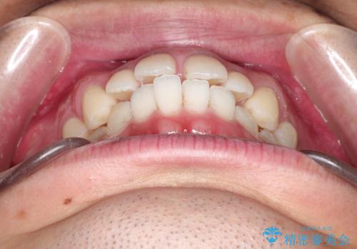 前歯の隙間を閉じたい　口元も下げたい　ハーフリンガルによる抜歯矯正の治療前