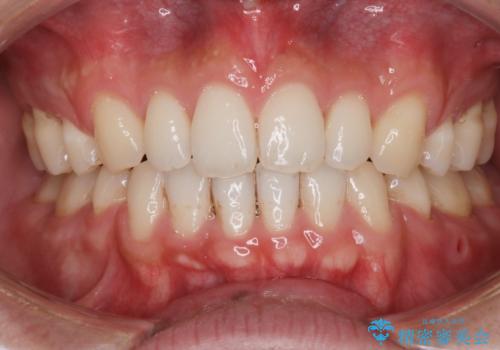 前歯の隙間を閉じたい　口元も下げたい　ハーフリンガルによる抜歯矯正の症例 治療後