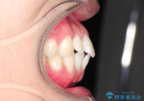 前歯の隙間を閉じたい 口元も下げたい ハーフリンガルによる抜歯矯正の治療前