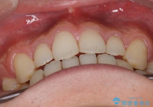 前歯の隙間を閉じたい 口元も下げたい ハーフリンガルによる抜歯矯正の治療後