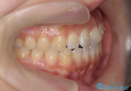 [ インビザライン ]前歯のねじれ、噛み合わせを治したいの治療中