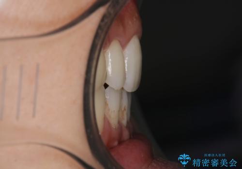 前歯の隙間を閉じたい 口元も下げたい ハーフリンガルによる抜歯矯正の治療後