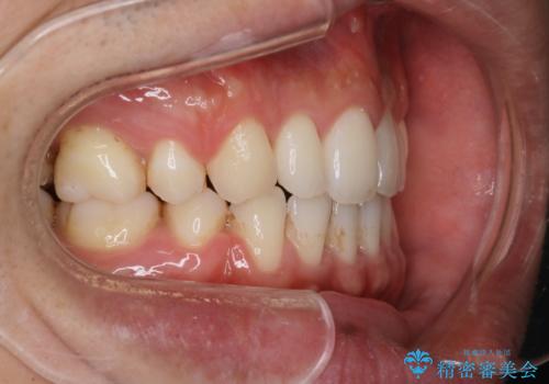 前歯の隙間を閉じたい　口元も下げたい　ハーフリンガルによる抜歯矯正の治療後