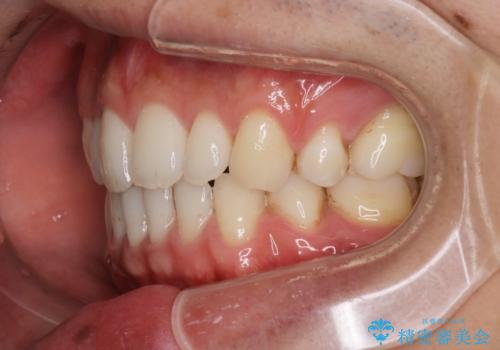 前歯の隙間を閉じたい 口元も下げたい ハーフリンガルによる抜歯矯正の治療後