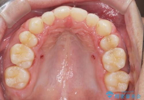 前歯の隙間を閉じたい 口元も下げたい ハーフリンガルによる抜歯矯正の治療後