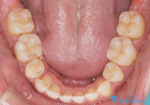 前歯の隙間を閉じたい 口元も下げたい ハーフリンガルによる抜歯矯正の治療後