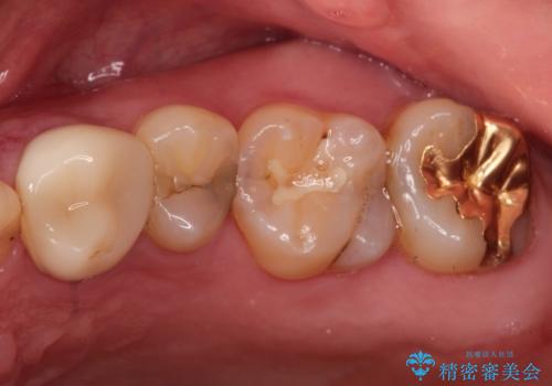【保険治療したところが再び虫歯に】セラミックインレーで治療の治療前