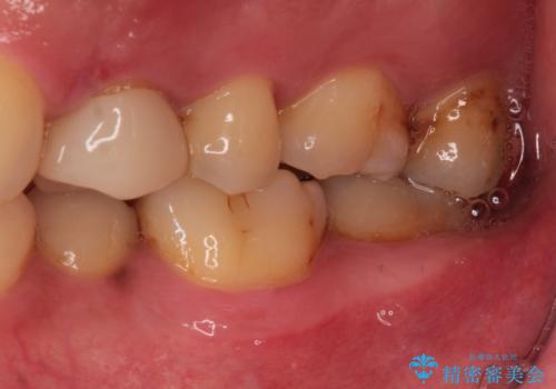 【保険治療したところが再び虫歯に】セラミックインレーで治療の治療前