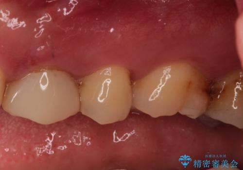 【保険治療したところが再び虫歯に】セラミックインレーで治療の治療前