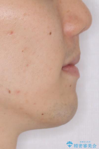 前歯の隙間を閉じたい 口元も下げたい ハーフリンガルによる抜歯矯正の治療後(顔貌)