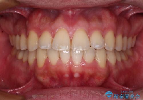 早くて安くて楽ちん メタルブラケットでの矯正治療の治療後