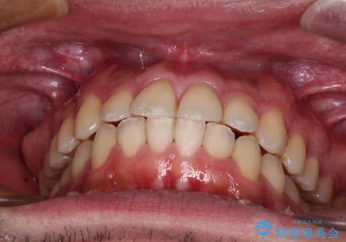 早くて安くて楽ちん メタルブラケットでの矯正治療の治療後