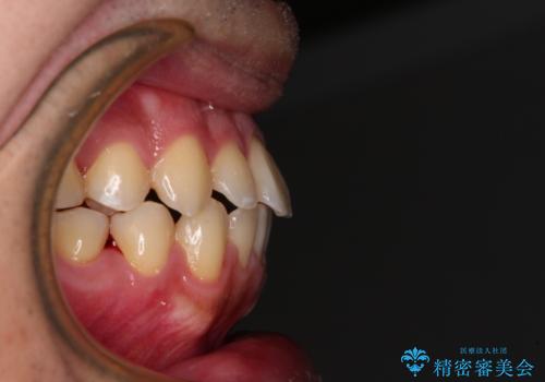 早くて安くて楽ちん メタルブラケットでの矯正治療の治療後