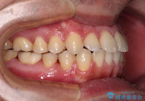 早くて安くて楽ちん メタルブラケットでの矯正治療の治療後