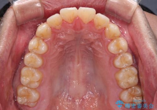 早くて安くて楽ちん メタルブラケットでの矯正治療の治療後