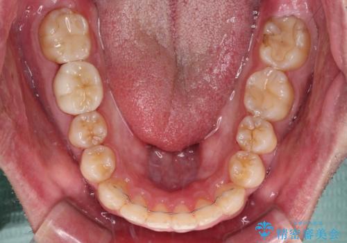 早くて安くて楽ちん メタルブラケットでの矯正治療の治療中