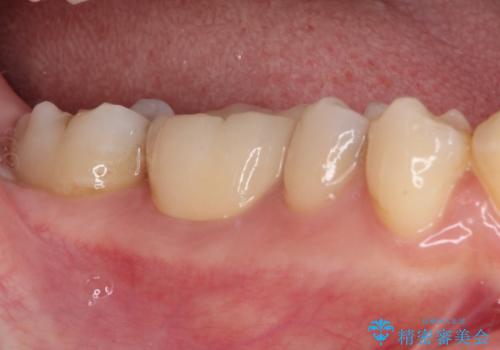 放置した虫歯　根管治療とオールセラミッククラウンの治療後