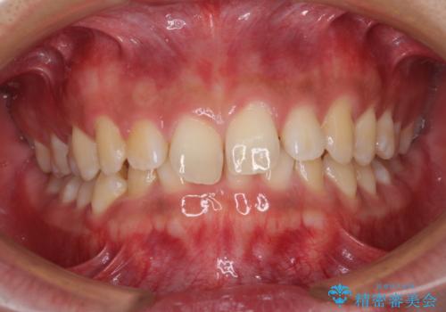 デコボコとディープバイトを治したい インビザラインによる矯正治療の症例 治療前