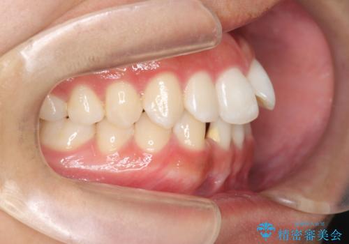 [ 先天性の前歯欠損 ]  マウスピース矯正とインプラント治療の治療前