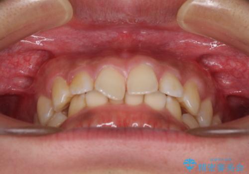 デコボコとディープバイトを治したい インビザラインによる矯正治療の治療前