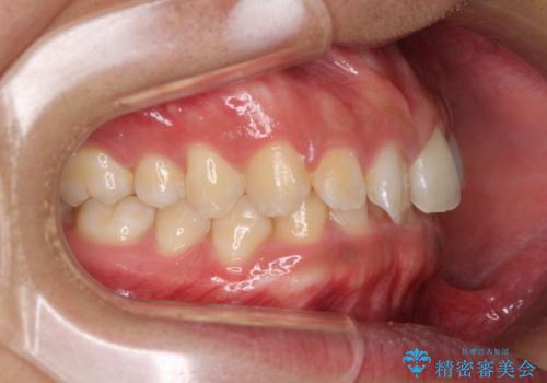デコボコとディープバイトを治したい インビザラインによる矯正治療の治療前