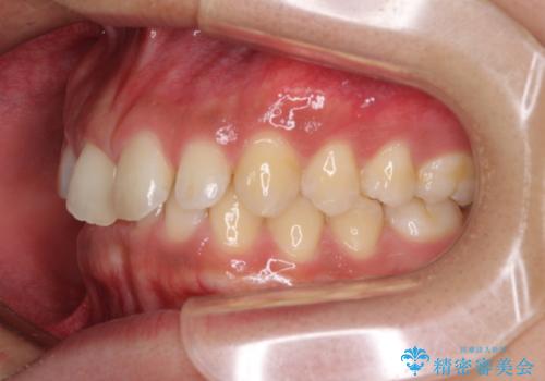 デコボコとディープバイトを治したい インビザラインによる矯正治療の治療前