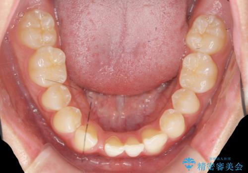 [ 先天性の前歯欠損 ]  マウスピース矯正とインプラント治療の治療前