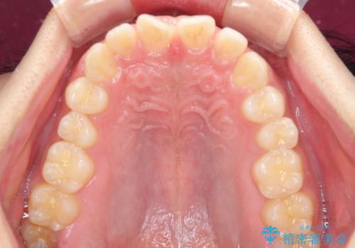デコボコとディープバイトを治したい インビザラインによる矯正治療の治療前