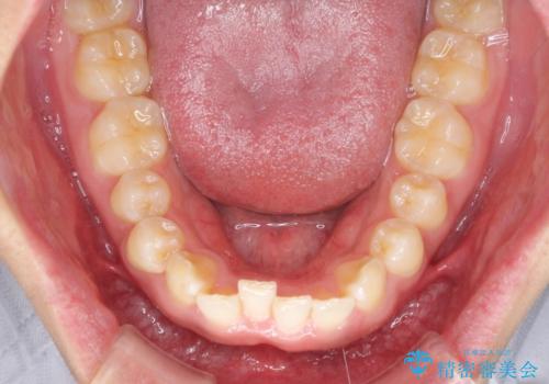 デコボコとディープバイトを治したい インビザラインによる矯正治療の治療前