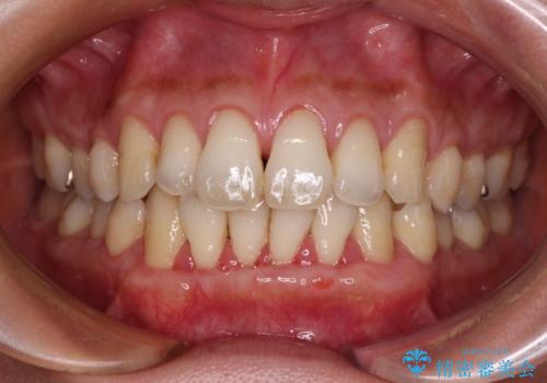 年々下がる歯茎を何とかしたい　歯肉移植術による根面被覆の治療中