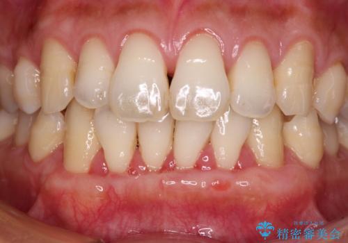 年々下がる歯茎を何とかしたい　歯肉移植術による根面被覆の治療中