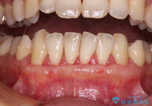年々下がる歯茎を何とかしたい 歯肉移植術による根面被覆の治療中