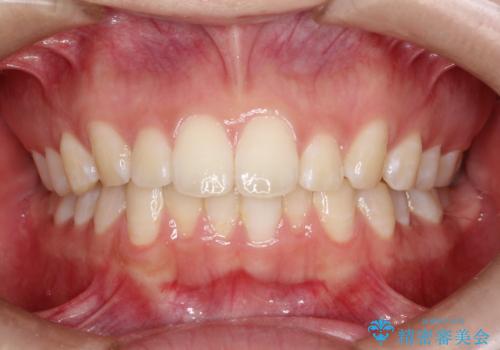 口元を下げてすっきりさせたい ワイヤー抜歯矯正で口元の改善の治療前