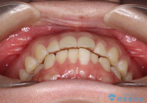 口元を下げてすっきりさせたい　ワイヤー抜歯矯正で口元の改善の治療前