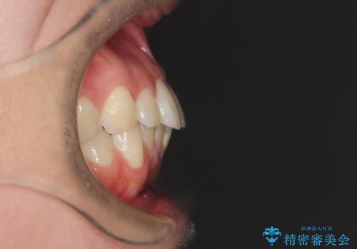 口元を下げてすっきりさせたい ワイヤー抜歯矯正で口元の改善の治療前