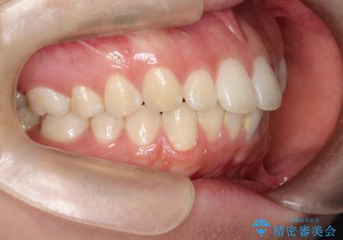 口元を下げてすっきりさせたい ワイヤー抜歯矯正で口元の改善の症例 治療前