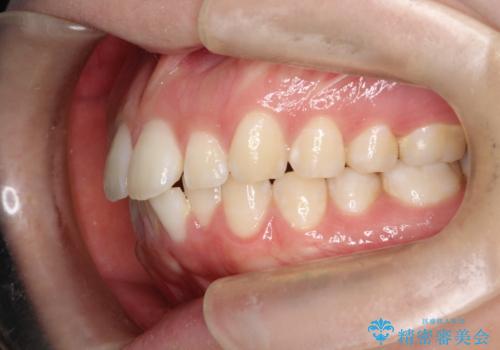 口元を下げてすっきりさせたい ワイヤー抜歯矯正で口元の改善の治療前