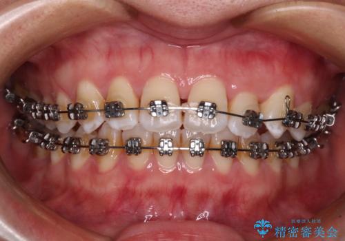 前歯の反対咬合 急速拡大装置とワイヤー装置であっという間の矯正治療の治療中
