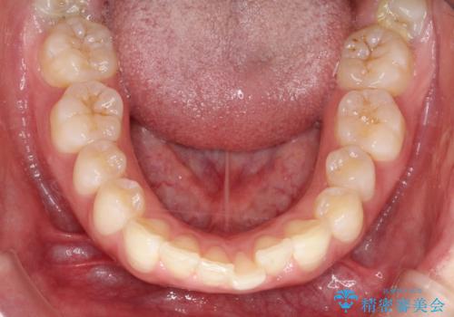 口元を下げてすっきりさせたい ワイヤー抜歯矯正で口元の改善の治療前