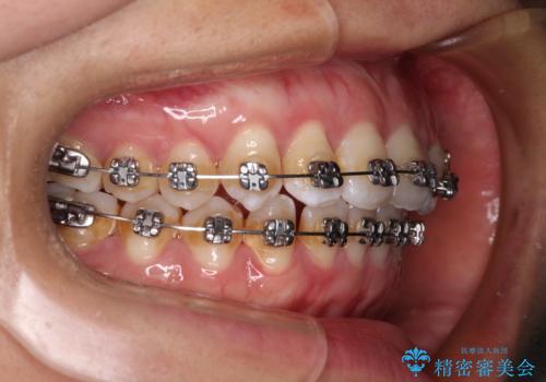 前歯の反対咬合 急速拡大装置とワイヤー装置であっという間の矯正治療の治療中