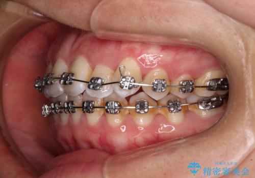 前歯の反対咬合 急速拡大装置とワイヤー装置であっという間の矯正治療の治療中