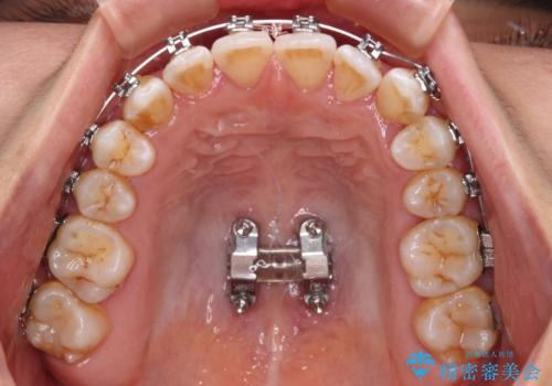前歯の反対咬合　急速拡大装置とワイヤー装置であっという間の矯正治療の治療中